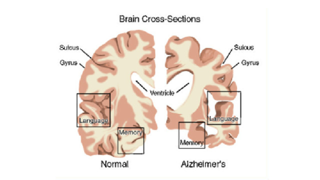 The Genetics underlying late-onset Alzheimer's Disease